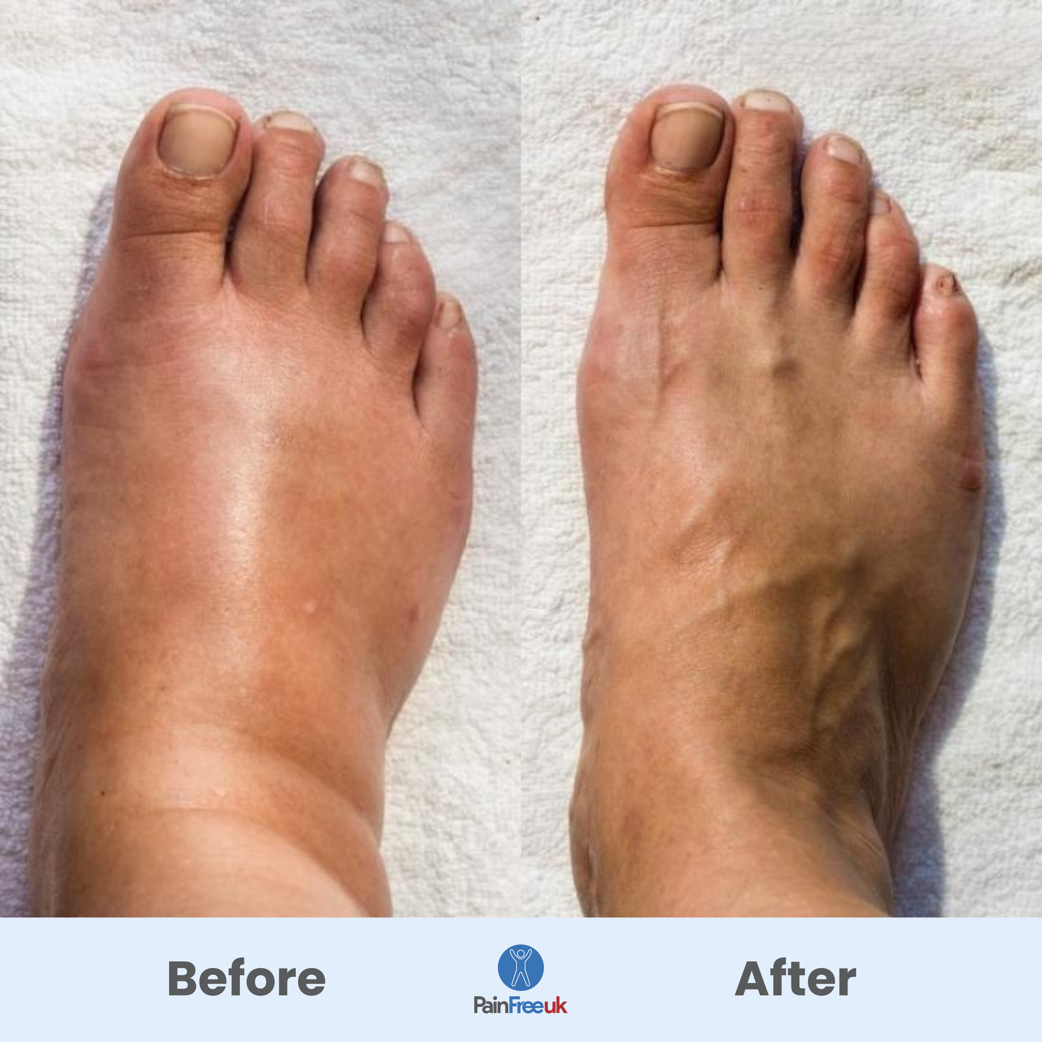 3x Pain Free UK™ Foot Massager - Quick Relief for Foot Pain in Just 15 Minutes a Day*